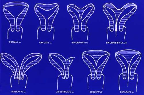 Infertilidad por malformación uterina